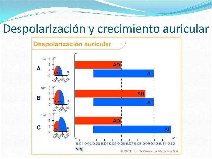 Despolarización y crecimiento auricular 