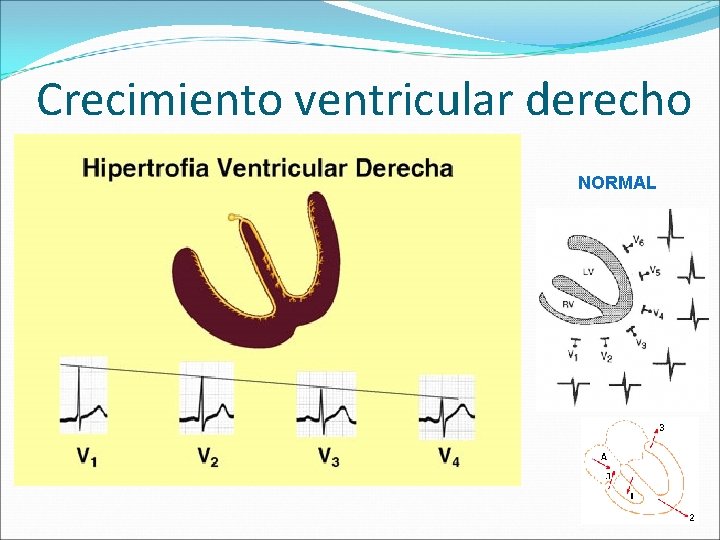 Crecimiento ventricular derecho NORMAL 