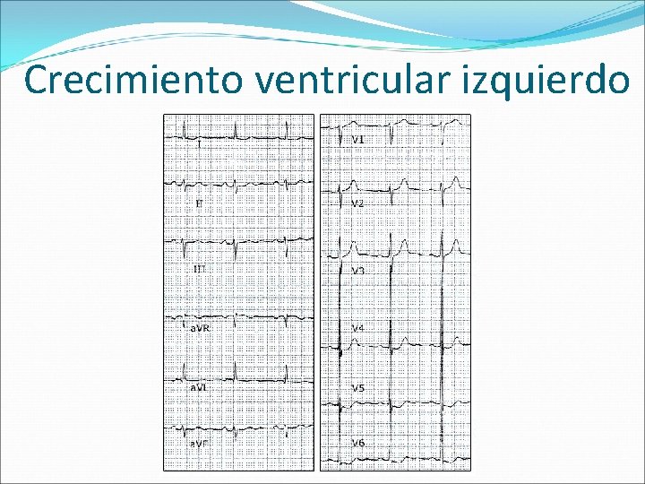 Crecimiento ventricular izquierdo 