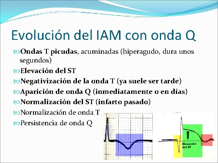 Evolución del IAM con onda Q Ondas T picudas, acuminadas (hiperagudo, dura unos segundos)