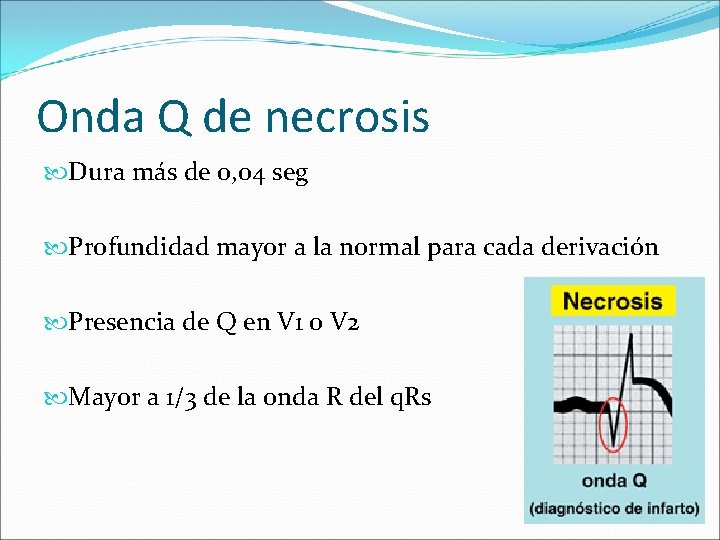 Onda Q de necrosis Dura más de 0, 04 seg Profundidad mayor a la