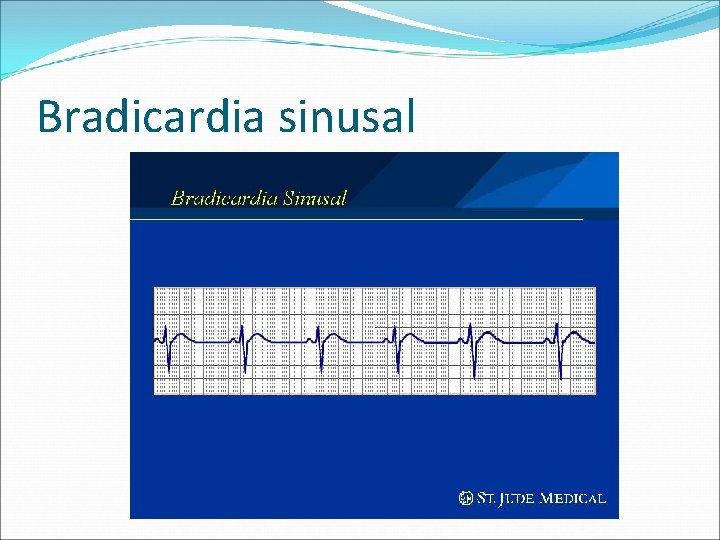 Bradicardia sinusal 