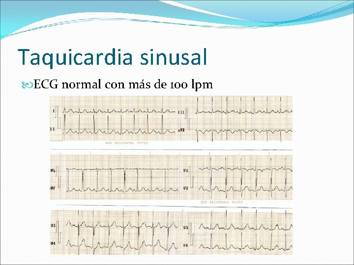 Taquicardia sinusal ECG normal con más de 100 lpm 