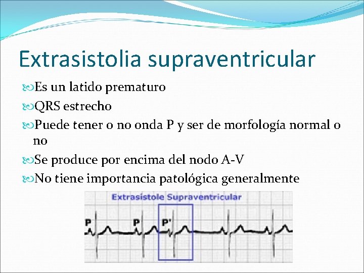 Extrasistolia supraventricular Es un latido prematuro QRS estrecho Puede tener o no onda P