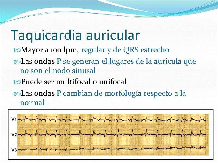 Taquicardia auricular Mayor a 100 lpm, regular y de QRS estrecho Las ondas P