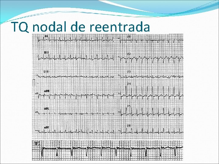 TQ nodal de reentrada 