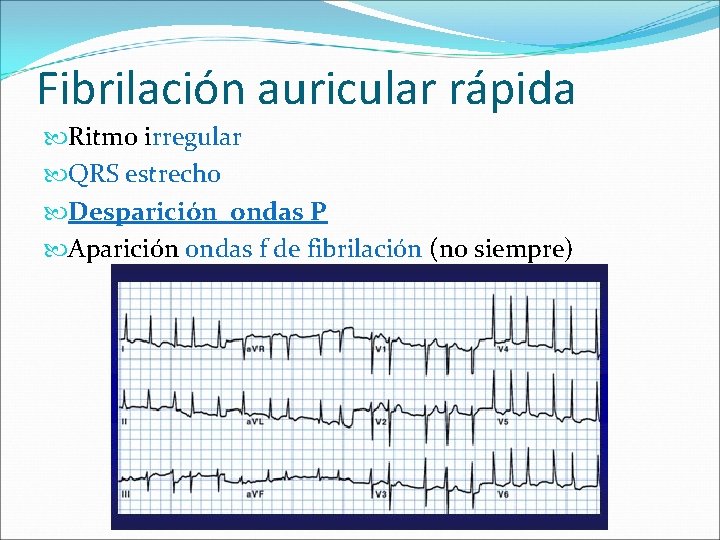 Fibrilación auricular rápida Ritmo irregular QRS estrecho Desparición ondas P Aparición ondas f de