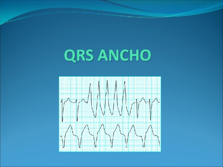 QRS ANCHO 