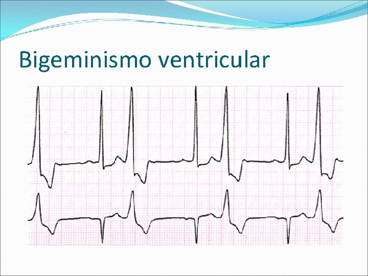 Bigeminismo ventricular 