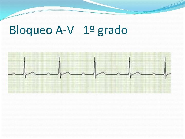 Bloqueo A-V 1º grado 