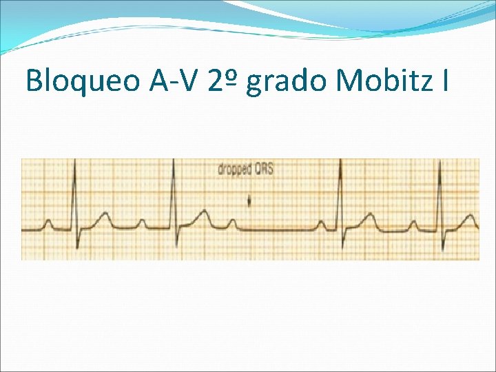 Bloqueo A-V 2º grado Mobitz I 