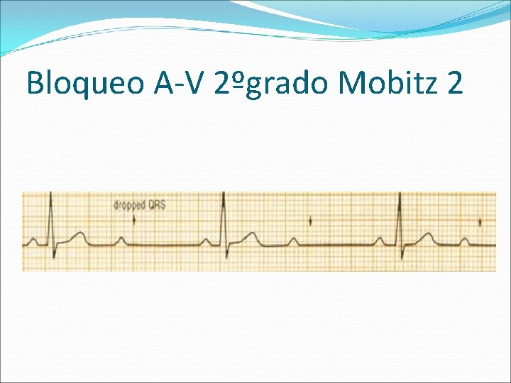 Bloqueo A-V 2ºgrado Mobitz 2 