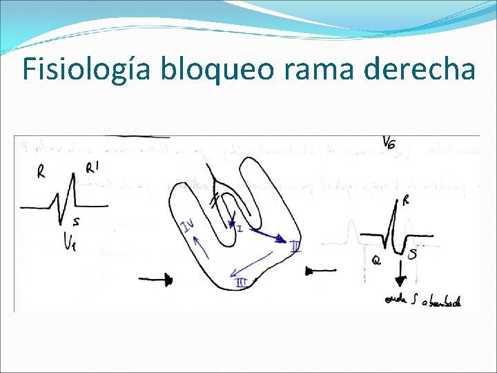 Fisiología bloqueo rama derecha 