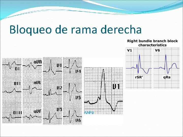 Bloqueo de rama derecha 