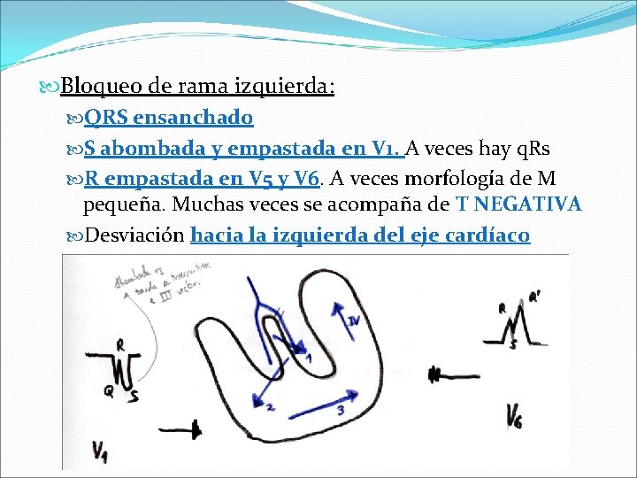  Bloqueo de rama izquierda: QRS ensanchado S abombada y empastada en V 1.