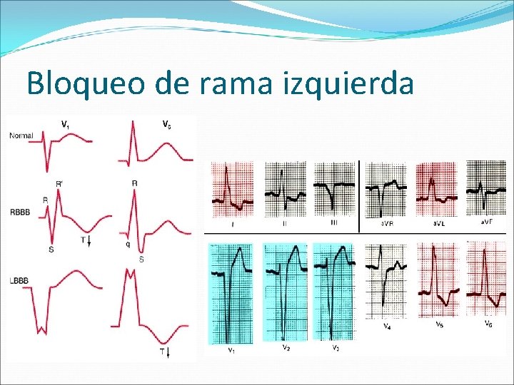 Bloqueo de rama izquierda 