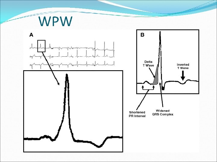 WPW 