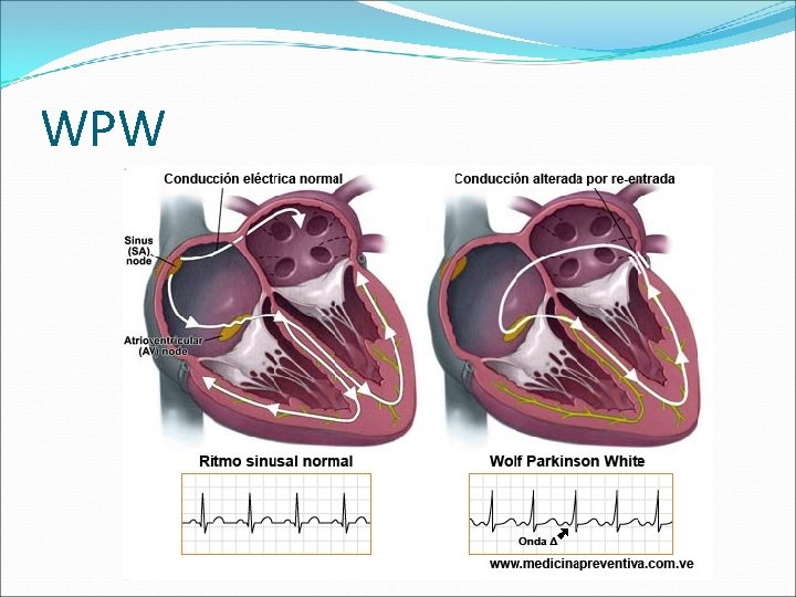 WPW 