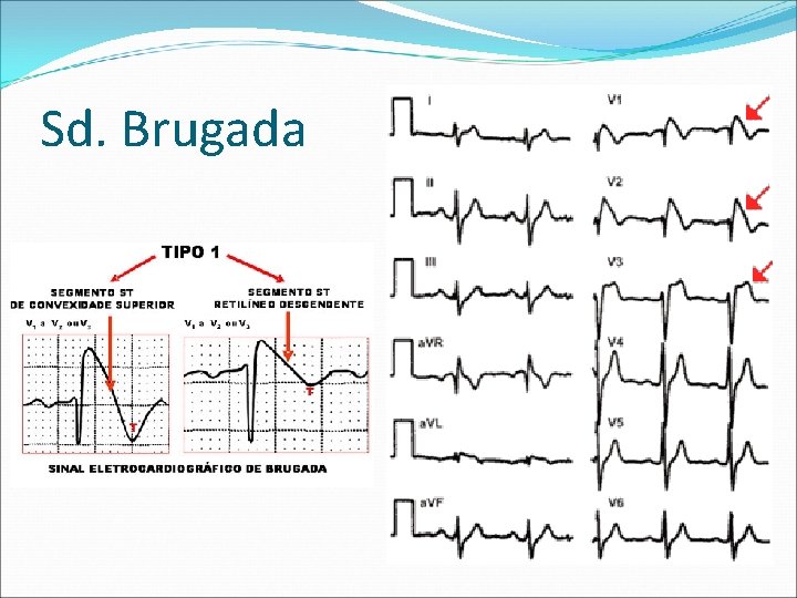 Sd. Brugada 