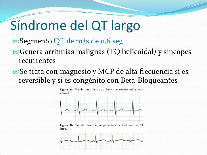 Síndrome del QT largo Segmento QT de más de 0, 6 seg Genera arritmias