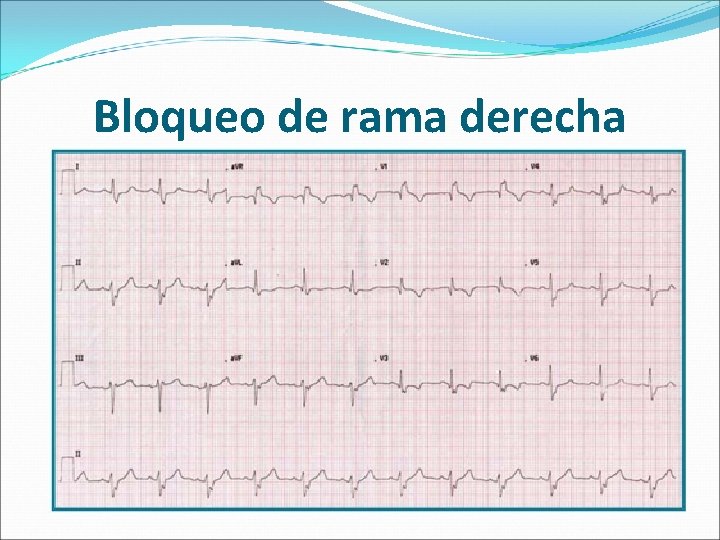 Bloqueo de rama derecha 