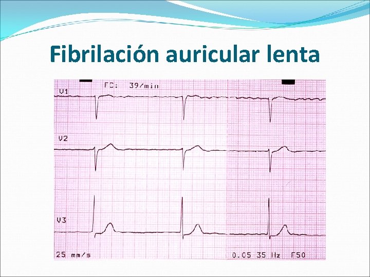 Fibrilación auricular lenta 