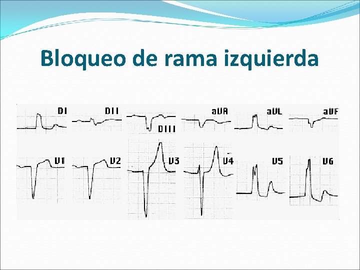 Bloqueo de rama izquierda 