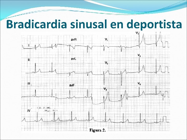 Bradicardia sinusal en deportista 