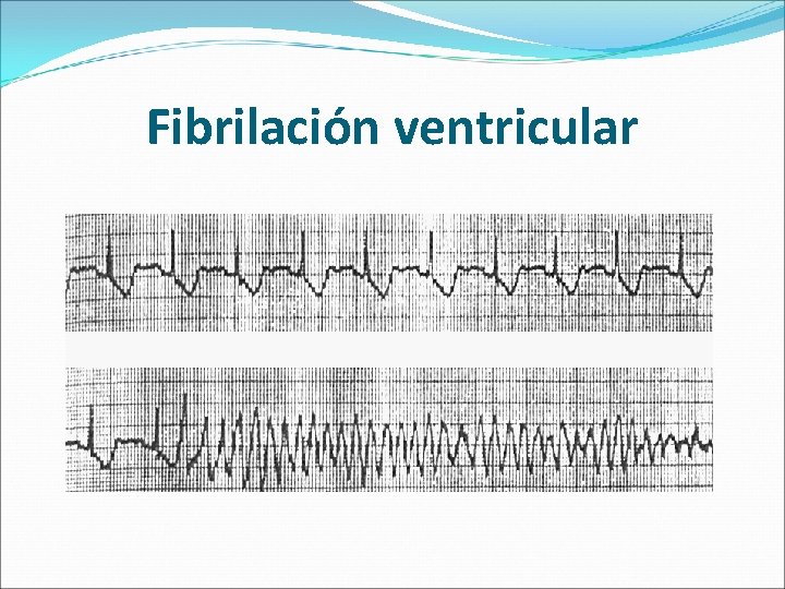 Fibrilación ventricular 