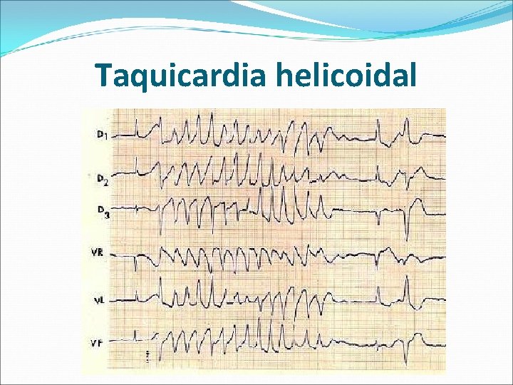 Taquicardia helicoidal 