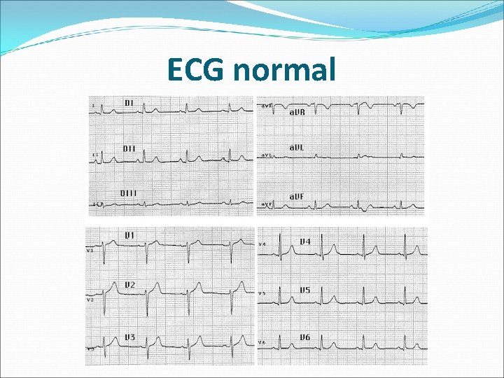 ECG normal 