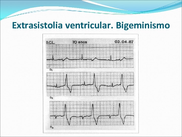 Extrasistolia ventricular. Bigeminismo 