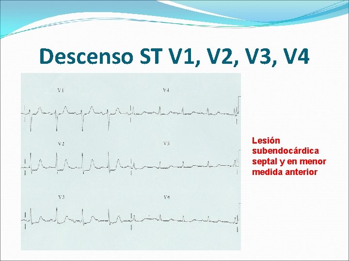 Descenso ST V 1, V 2, V 3, V 4 Lesión subendocárdica septal y