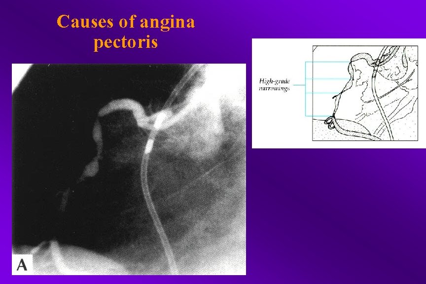 Causes of angina pectoris 