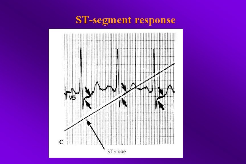 ST-segment response 