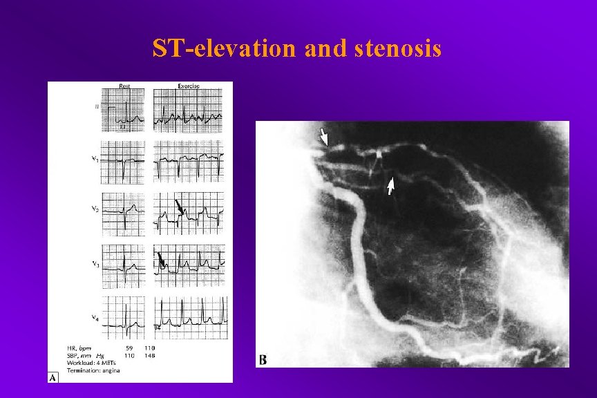 ST-elevation and stenosis 