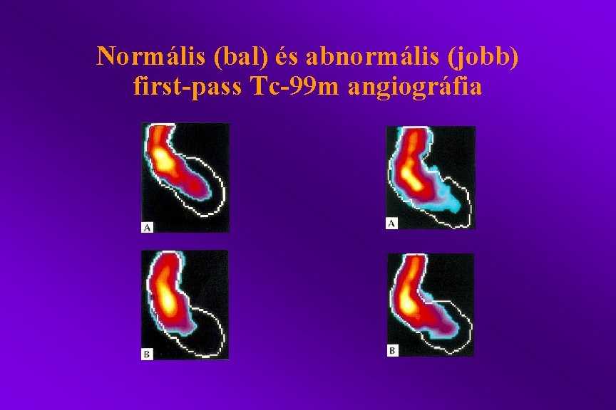 Normális (bal) és abnormális (jobb) first-pass Tc-99 m angiográfia 