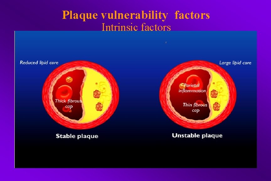 Plaque vulnerability factors Intrinsic factors 