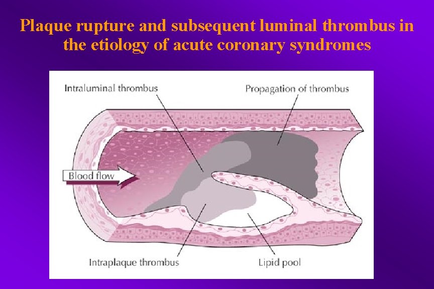 Plaque rupture and subsequent luminal thrombus in the etiology of acute coronary syndromes 