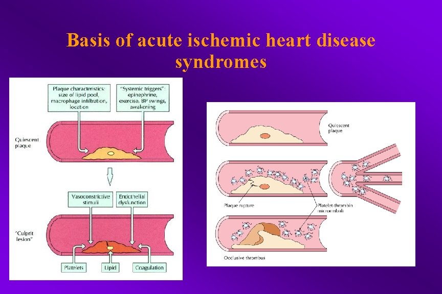 Basis of acute ischemic heart disease syndromes 