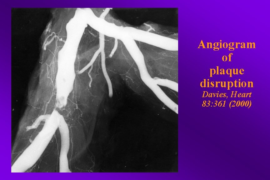 Angiogram of plaque disruption Davies, Heart 83: 361 (2000) 