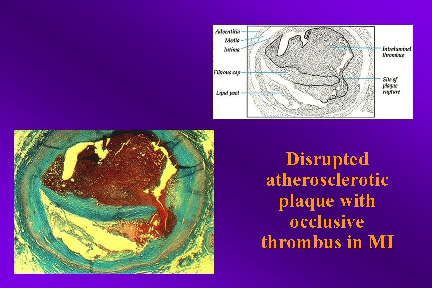 Disrupted atherosclerotic plaque with occlusive thrombus in MI 