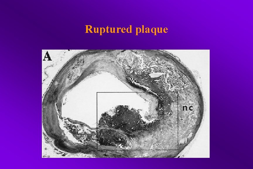 Ruptured plaque 