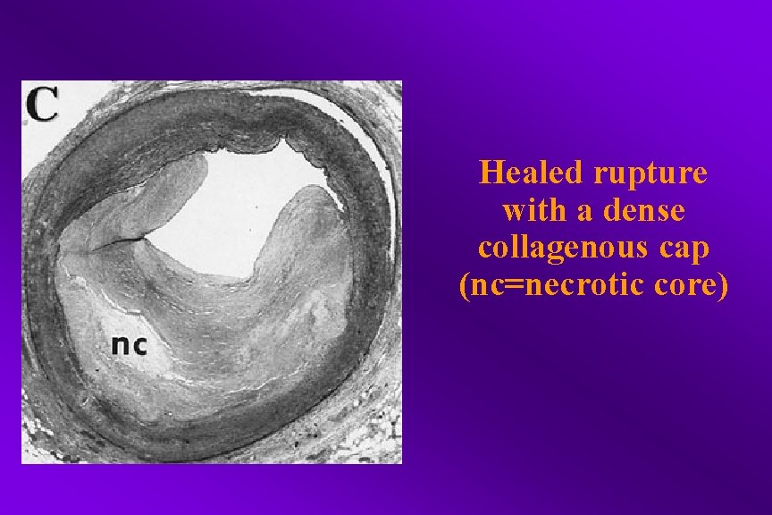 Healed rupture with a dense collagenous cap (nc=necrotic core) 