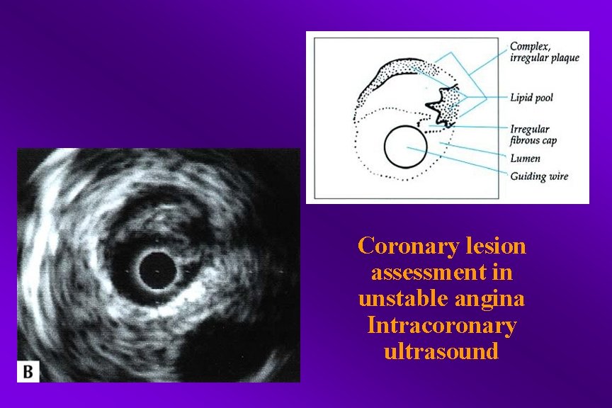 Coronary lesion assessment in unstable angina Intracoronary ultrasound 