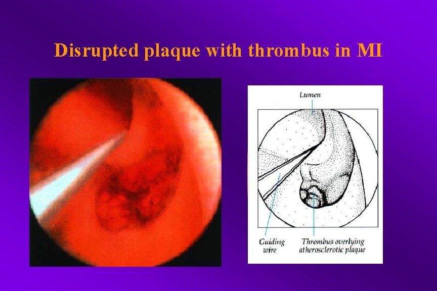 Disrupted plaque with thrombus in MI 