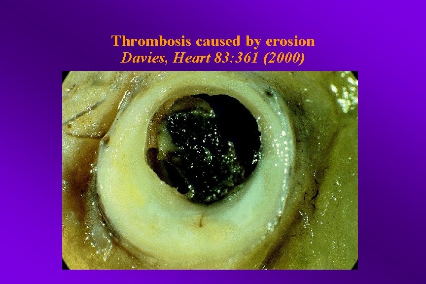 Thrombosis caused by erosion Davies, Heart 83: 361 (2000) 