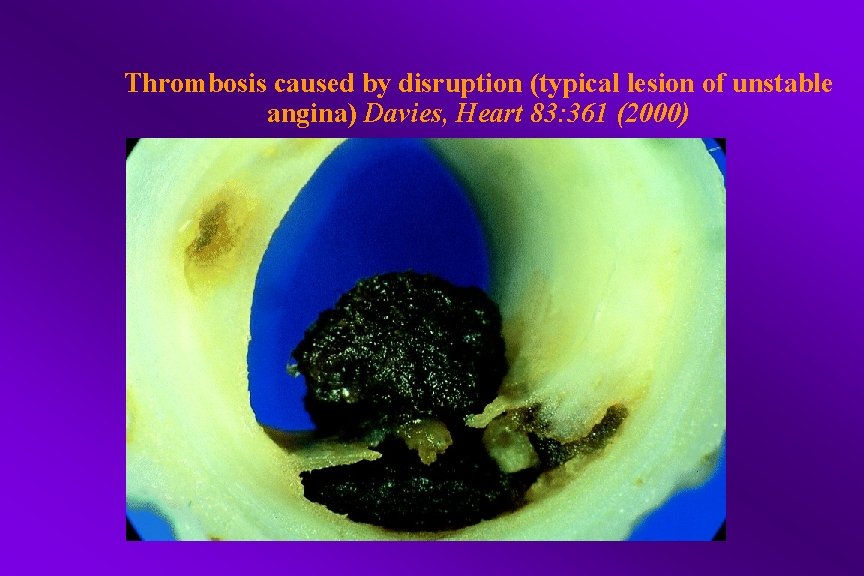 Thrombosis caused by disruption (typical lesion of unstable angina) Davies, Heart 83: 361 (2000)