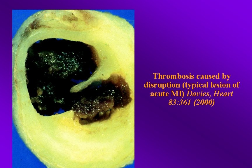 Thrombosis caused by disruption (typical lesion of acute MI) Davies, Heart 83: 361 (2000)