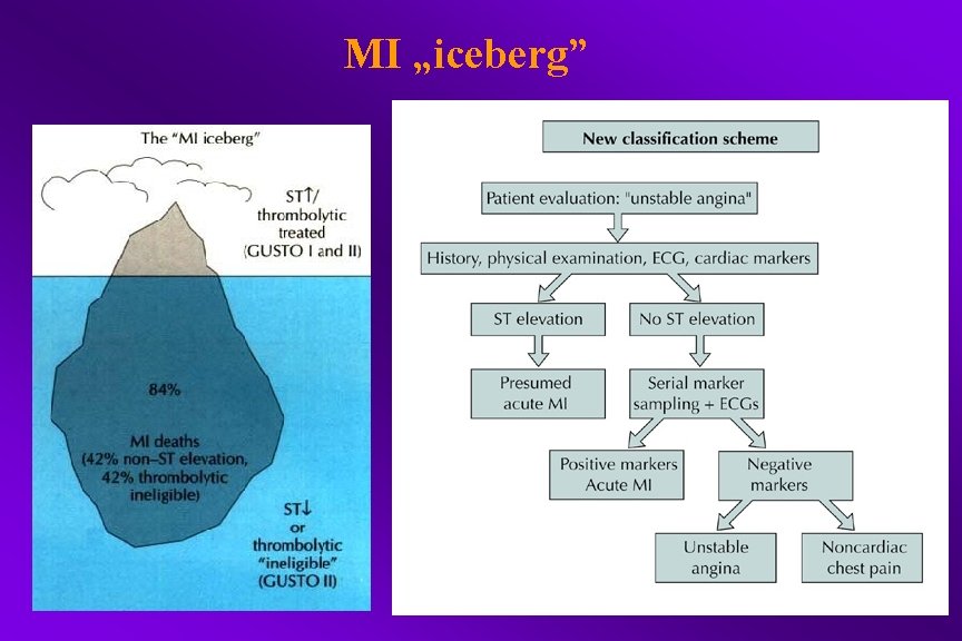 MI „iceberg” 